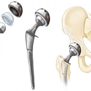mhsds-joint-replacement mhsds-joint-replacement